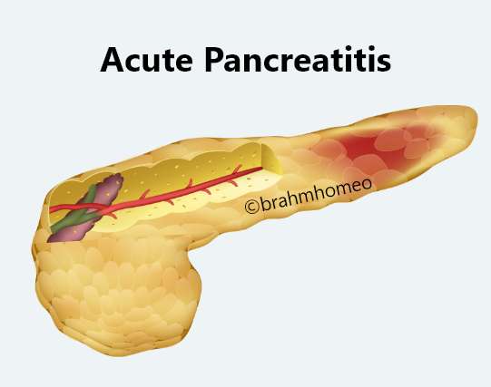 Acute pancreatitis