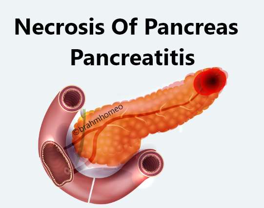 Necrosis of pancreas pancreatitis